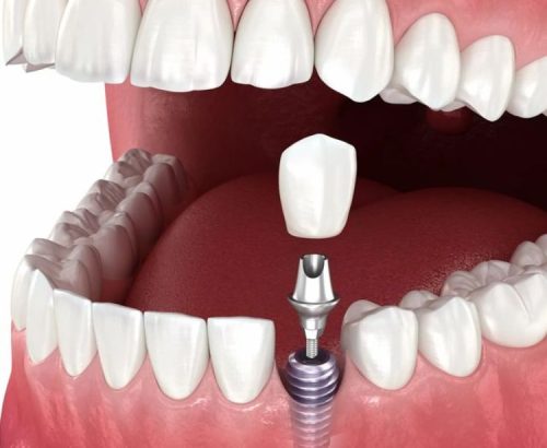 Dental implant -2
